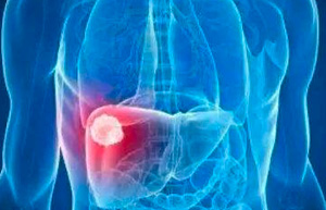 肝癌是中国第二大肿瘤致死病因！你是高危人群吗？